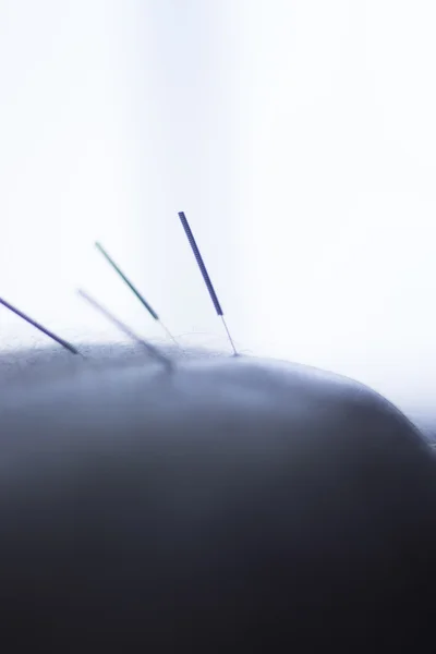 Agujas de acupuntura de agujas secas — Foto de Stock