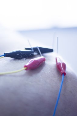 Electroacupunture acupunture iğneler