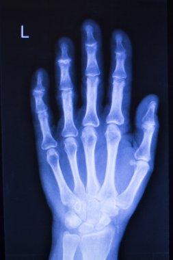 El yaralanma parmak xray tarama