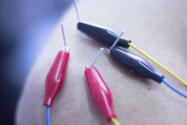 Electroacupunture acupunture iğneler