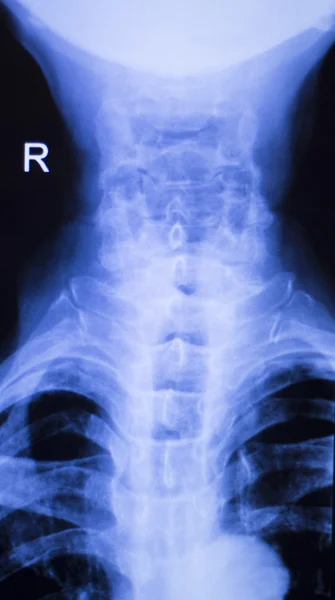 Nyak és a gerinc sérülés xray scan — Stock Fotó