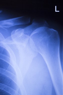 Omuz eklem ortopedik xray inceden inceye gözden geçirmek