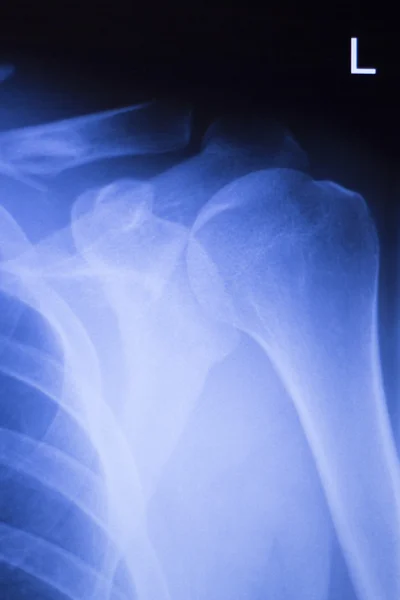 Shoulder joint orthopedic xray scan — Stock Photo, Image