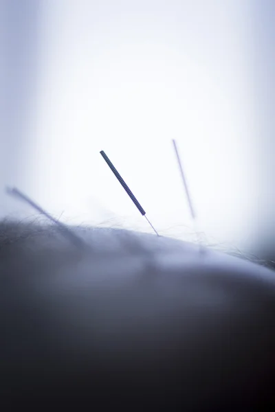 Kuru iğneleme yöntemlerinin etkinliğinin karşılaştırılması acupunture iğneler — Stok fotoğraf