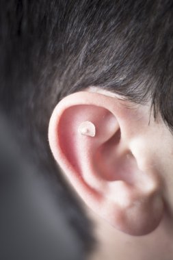Auriculartherapy ear seed treatment clipart
