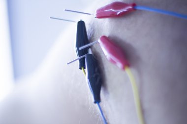 Electroacupunture acupunture iğneler