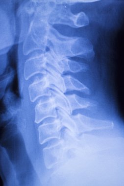 Boyun ve Omurga yaralanması xray tarama