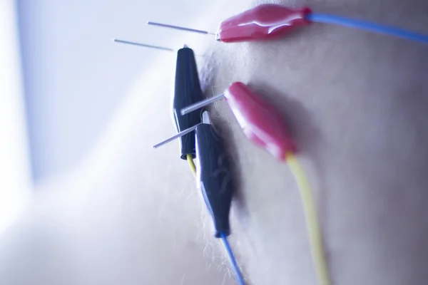 Agujas de acupuntura electroacupuntura —  Fotos de Stock