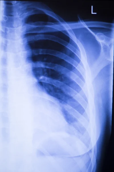 Shoulder joint orthopedic xray scan — Stock Photo, Image