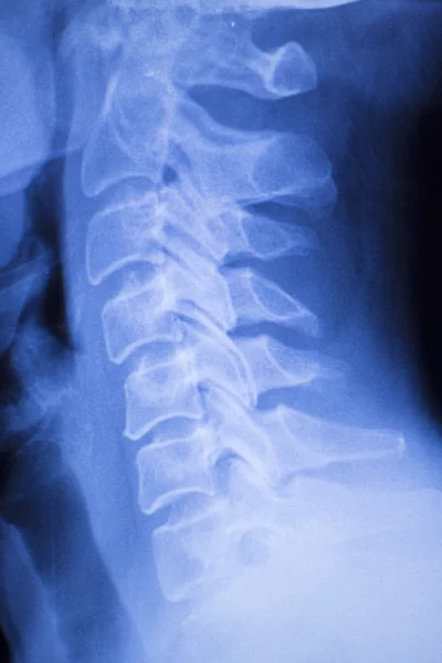 Neck and spine injury xray scan — Stock Photo, Image