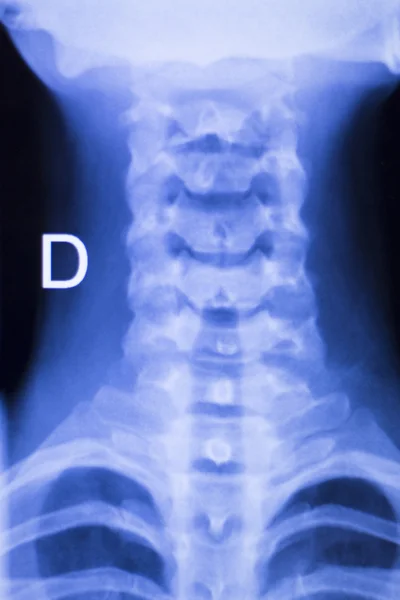 Neck and spine injury xray scan — Stock Photo, Image