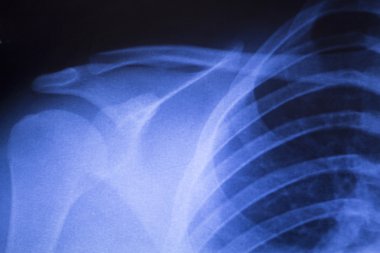 Omuz eklem ortopedik xray inceden inceye gözden geçirmek