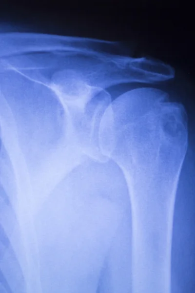 肩关节矫形 x 线扫描 — 图库照片