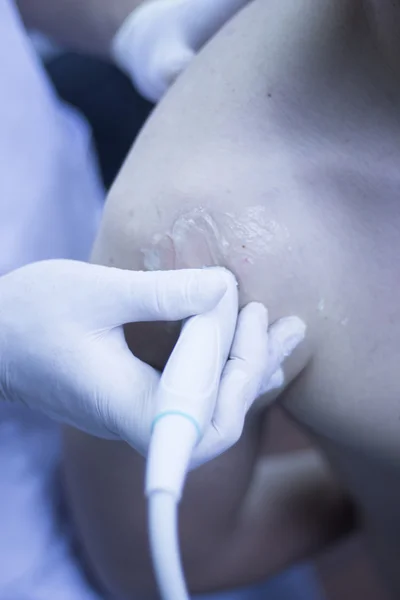 EPI percutaneous intratissue electrolysis — Stock Photo, Image