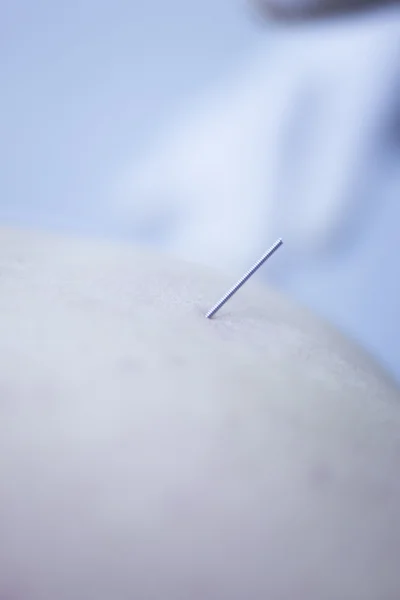 Kuru iğneleme yöntemlerinin etkinliğinin karşılaştırılması acupunture terapi — Stok fotoğraf