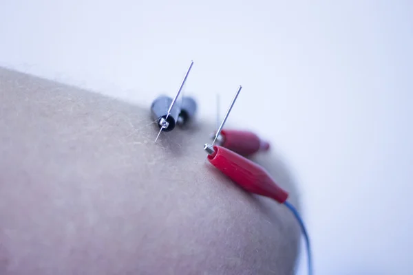 Electroacupunture acupunture 바늘 — 스톡 사진