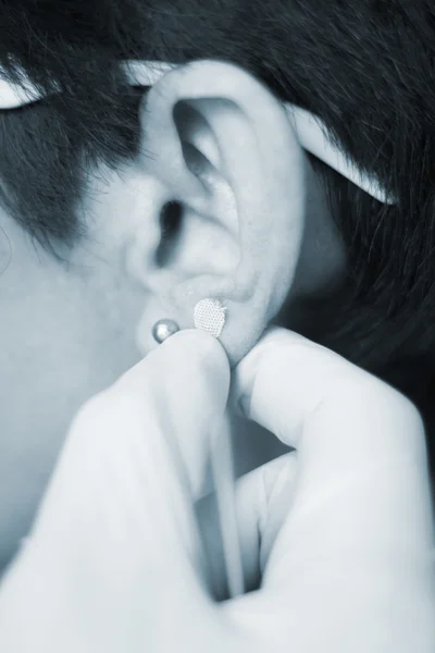 Auriculartherapy kulak tohum tedavi — Stok fotoğraf
