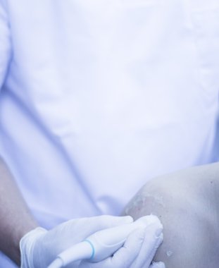 Epi perkütan intratissue elektroliz