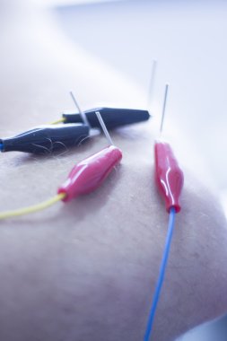 Electroacupunture acupunture iğneler