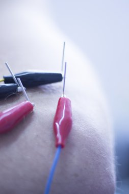 Electroacupunture acupunture iğneler
