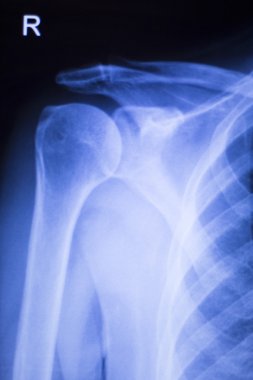 Omuz eklem ortopedik xray inceden inceye gözden geçirmek