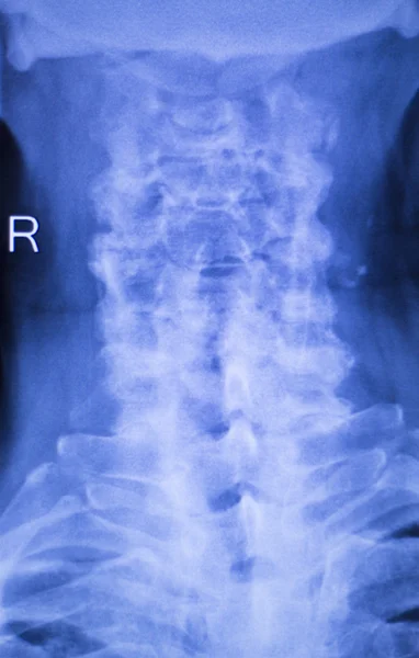 Röntgenbild von Verletzungen an Hals und Wirbelsäule — Stockfoto