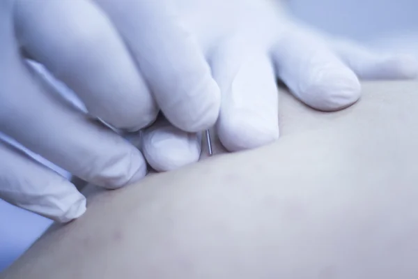 Terapia de acupuntura con agujas secas —  Fotos de Stock