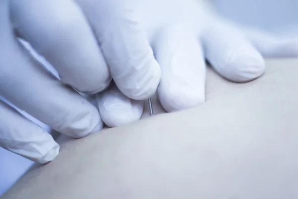 Dry needling acupunture therapy — Stock Photo, Image