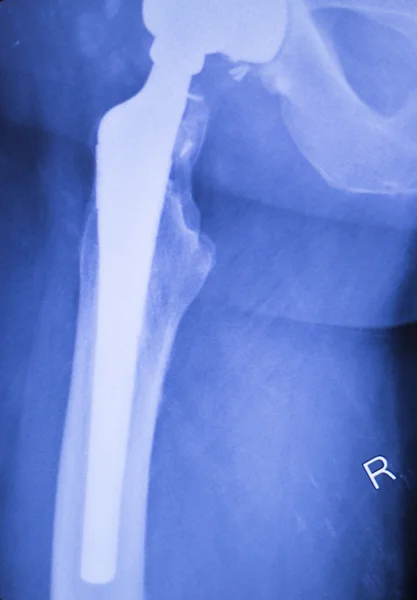 Radiografía de implante ortopédico de reemplazo de cadera — Foto de Stock