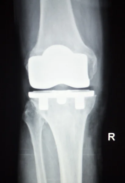 Impianto ortopedico articolare del ginocchio radiografia — Foto Stock