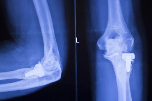 Articulação do cotovelo ortopedia implante xray — Fotografia de Stock