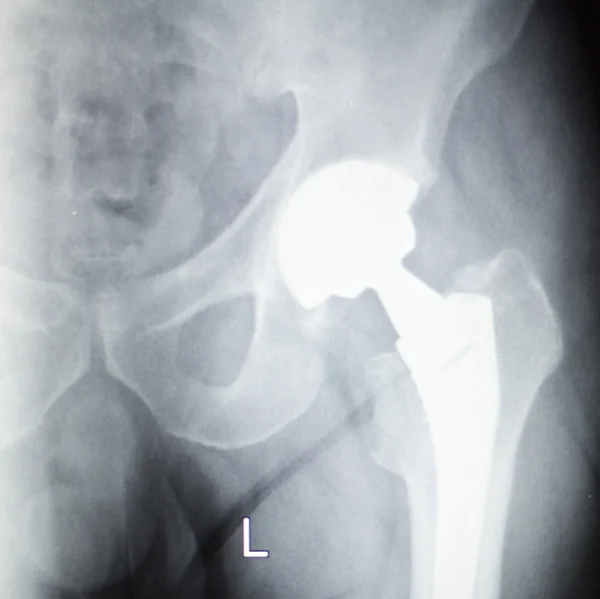 Radiografía de implante ortopédico de reemplazo de cadera — Foto de Stock