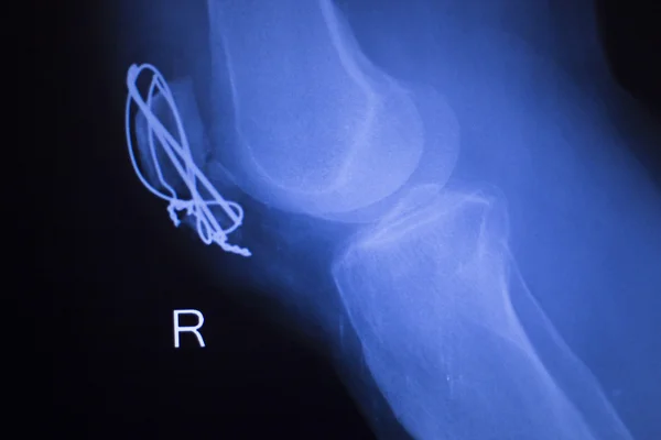 Kolena společné ortopedie implantát xray — Stock fotografie