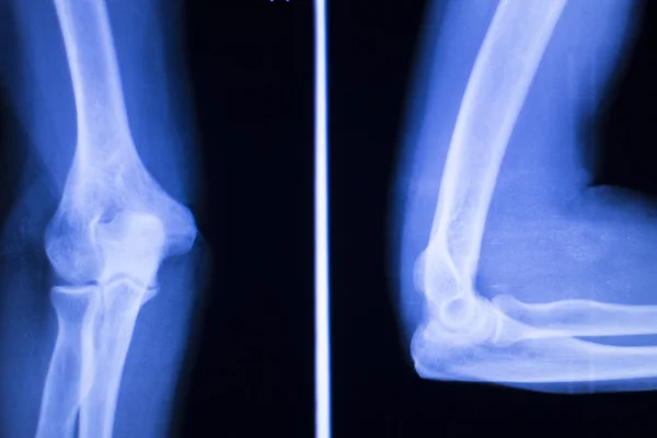 Elleboog gezamenlijke orthopedie implantaat xray — Stockfoto