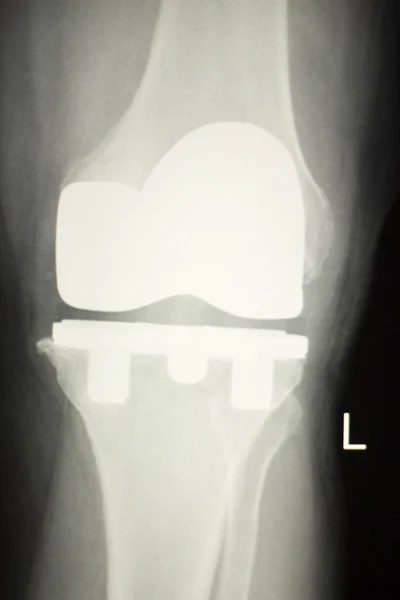 Knä gemensamma ortopedi implantat xray — Stockfoto