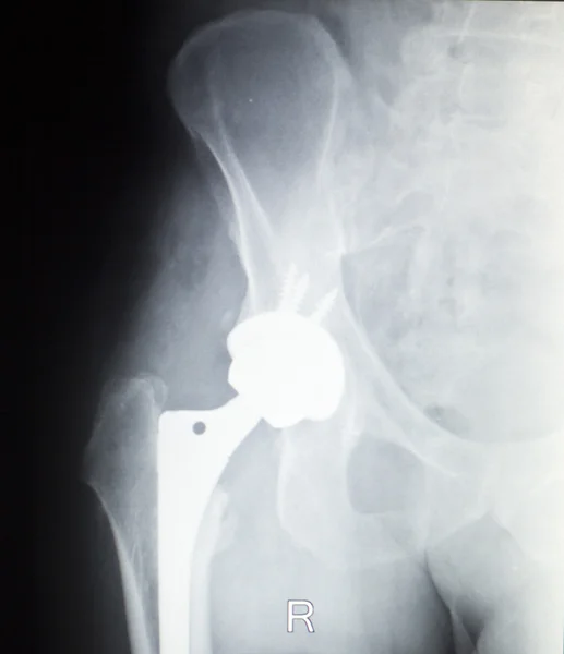 Radiografia de prótese ortopédica de substituição do quadril — Fotografia de Stock