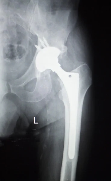 Radiografia de prótese ortopédica de substituição do quadril — Fotografia de Stock