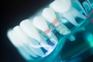 Diş çürüğü modeli dişlerdeki bakterileri gösteriyor.