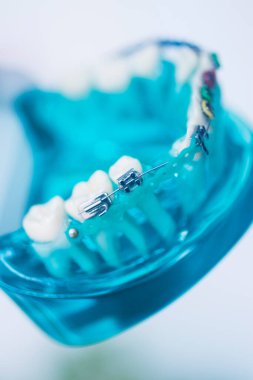 Diş macunu hizalayıcı diş etleri ve metal diş düzleştiricileri gösteren öğrenci modeli öğretiyor..