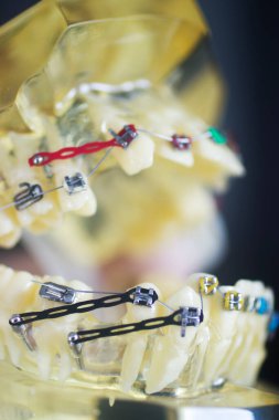 Diş macunu hizalayıcı diş etleri ve metal diş düzleştiricileri gösteren öğrenci modeli öğretiyor..