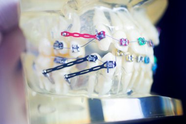 Diş macunu hizalayıcı diş etleri ve metal diş düzleştiricileri gösteren öğrenci modeli öğretiyor..