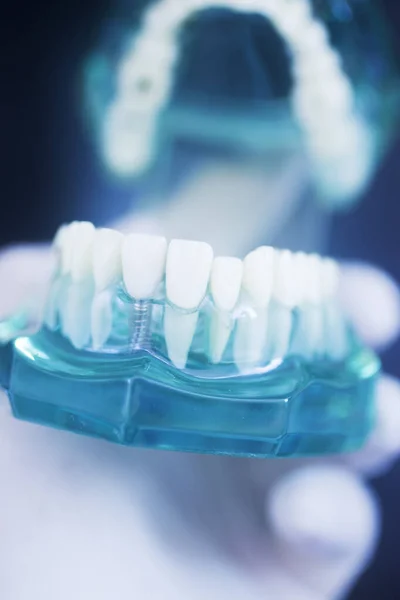 Modèle Prothèse Dentaire Titane Pour Implants Dentaires — Photo