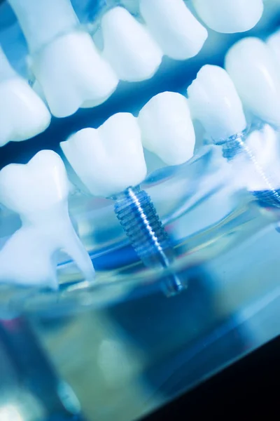 Implante Dental Modelo Dentistas Protésicos Titanio — Foto de Stock