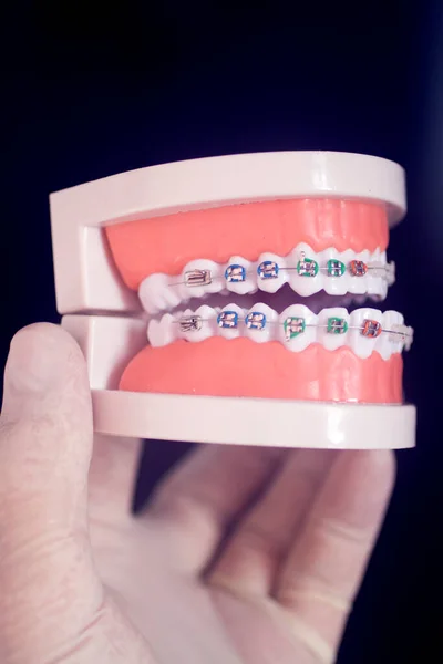 Dental Teeth Aligner Bracket Teaching Student Model Showing Gums Metal — Stock Photo, Image