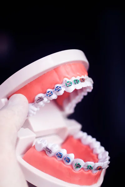 Zubní Zuby Rovnátka Závorky Výuka Studentský Model Ukazující Dásně Kovové — Stock fotografie