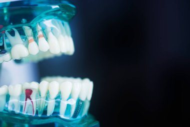 Diş çürüğü modeli dişlerdeki bakterileri gösteriyor.