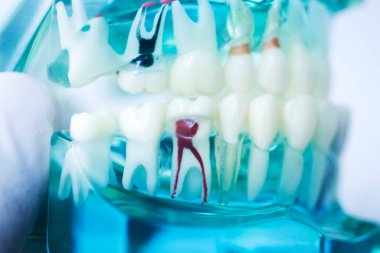 Diş çürüğü modeli dişlerdeki bakterileri gösteriyor.