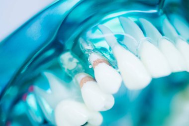 Diş çürüğü modeli dişlerdeki bakterileri gösteriyor.