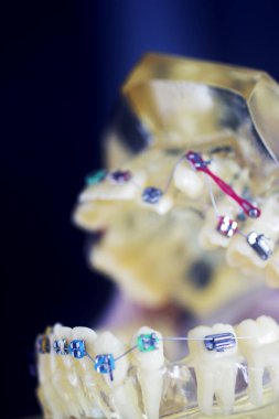 Diş macunu hizalayıcı diş etleri ve metal diş düzleştiricileri gösteren öğrenci modeli öğretiyor..