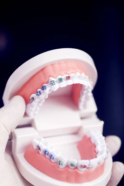 Zubní Zuby Rovnátka Závorky Výuka Studentský Model Ukazující Dásně Kovové — Stock fotografie